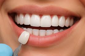 Teeth veneers